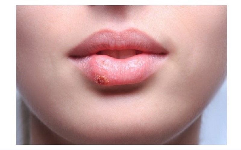 Understanding the Causes and Treatment of Water Blisters from Lip Tattoos.