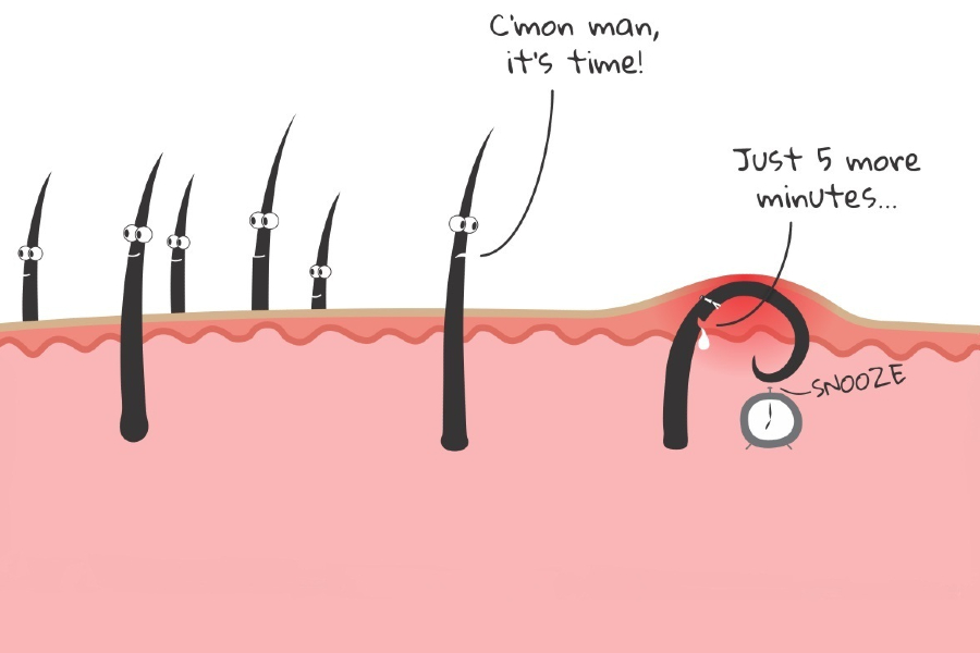 Indications and manifestations of ingrown hairs.