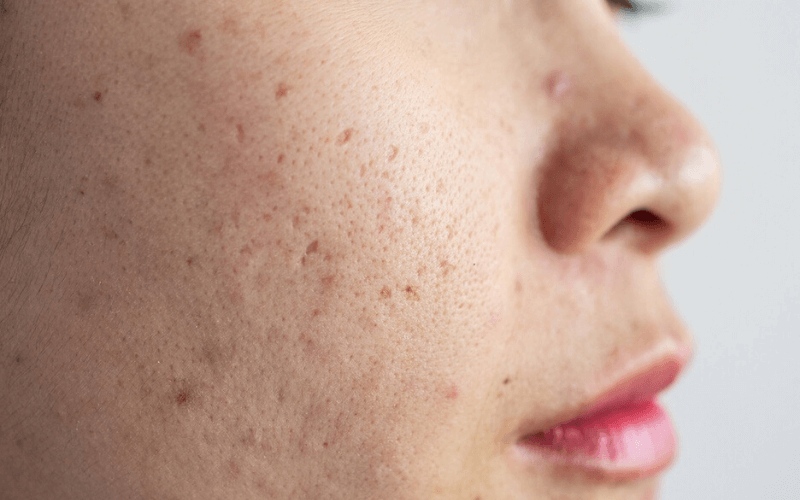 If you have acne or dark spots, melasma, biological skin peeling is the first effective method.