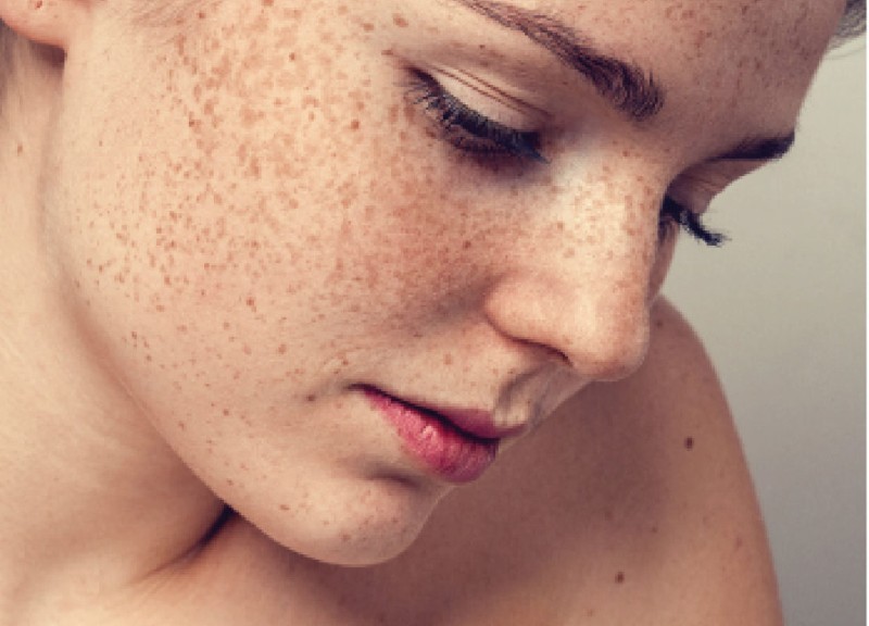 Endocrine pigmentation is a concern for many women.