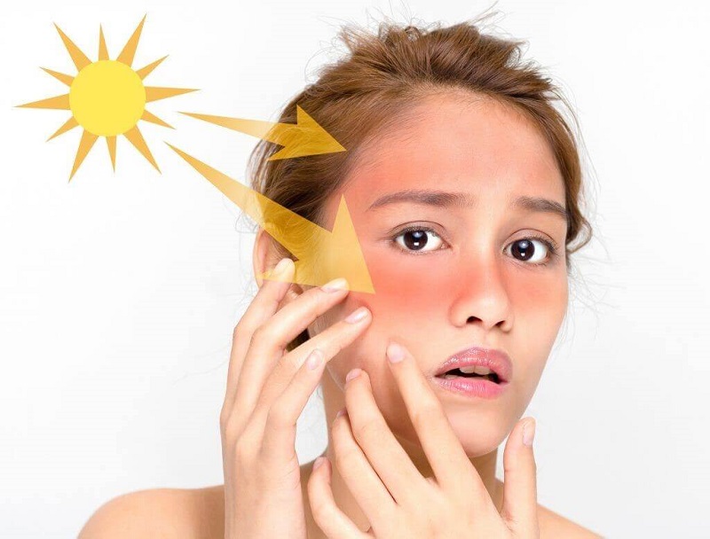 washing face with fresh milk causes sunburn