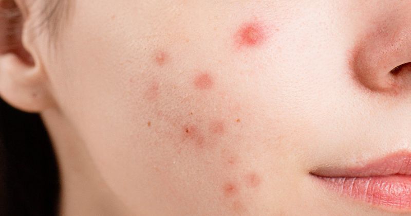 After giving birth, many mothers experience the appearance of pustules and whiteheads (Photo: Collected from the Internet).