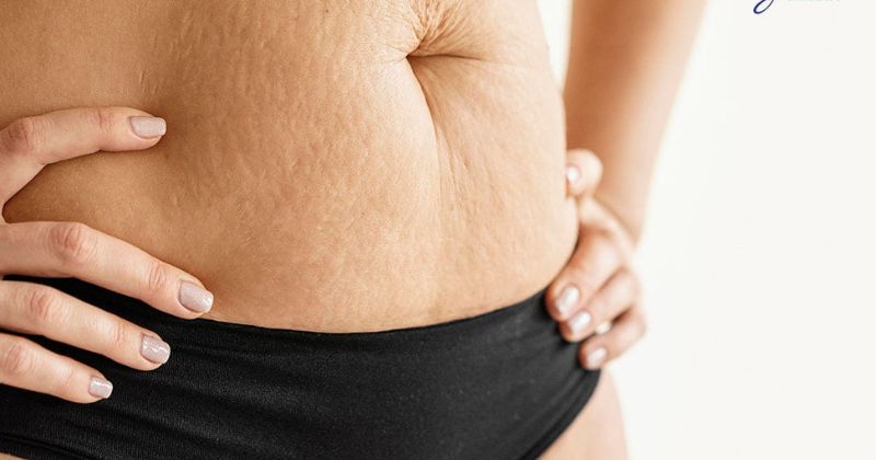 Postpartum stretch marks can cause a loss of confidence for many women (Photo: Collected from the Internet).