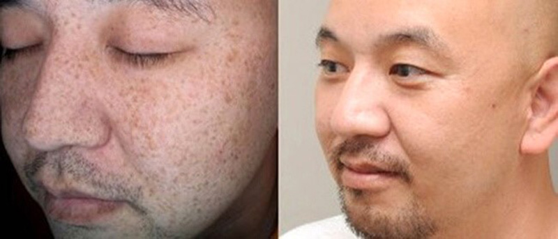 Increase the Effectiveness of Melasma Treatment with Nutrient-Rich Diet and Healthy Lifestyle
