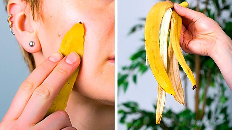 Banana peels are highly effective in eliminating stubborn acne.