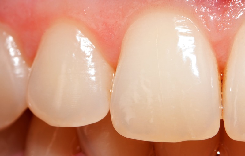 Enamel is the hard outer layer of the tooth.