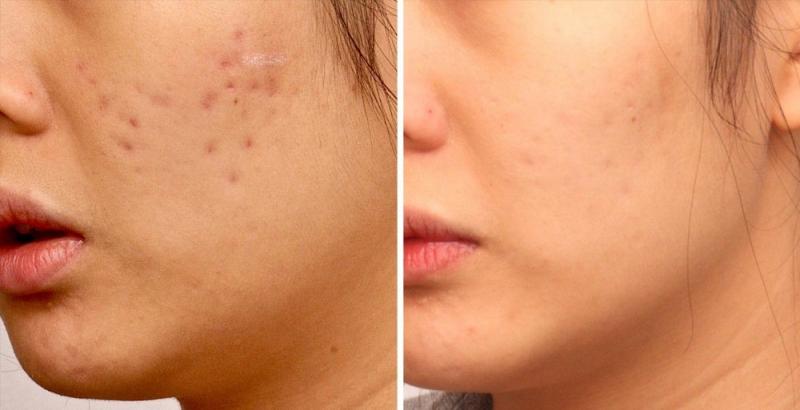 Salicylic acid effectively fades acne scars