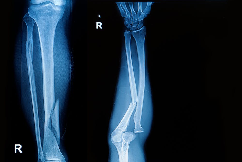 Signs and symptoms of a broken leg can include intense pain