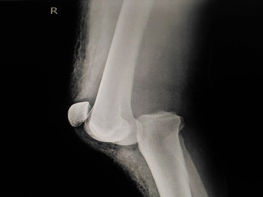 symptoms of knee dislocation