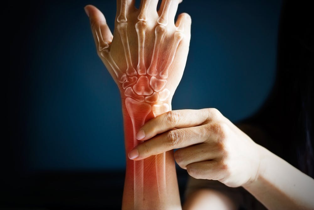 This injury is also referred to as wrist arthritis.