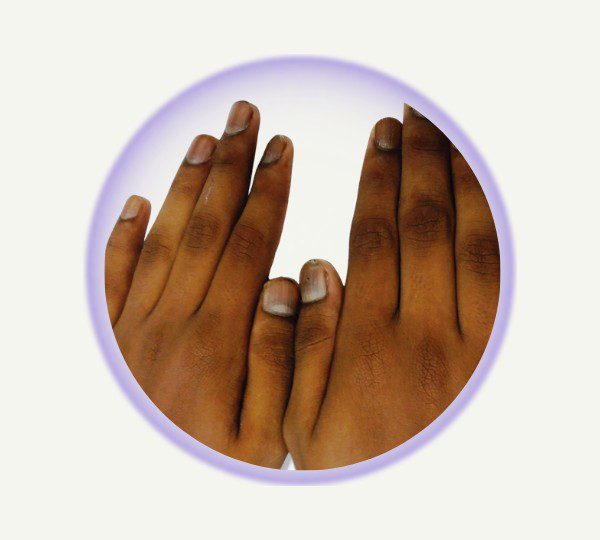Treating severe darkened hand skin