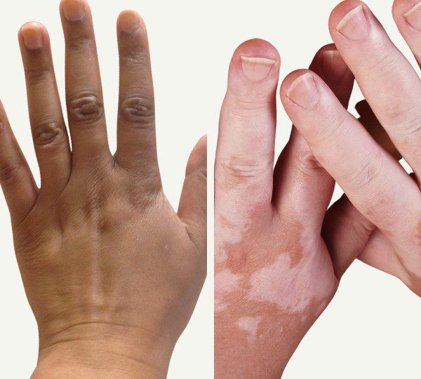 Examine the progression of factors leading to darkening of the hand skin from light to dark.